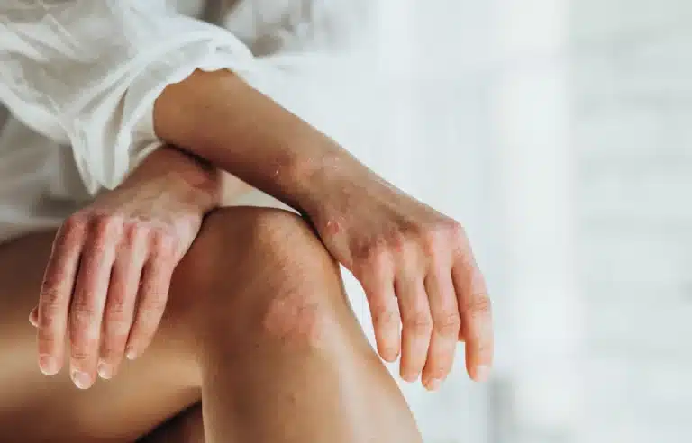 Femeie cu psoriazis pe mâini și genunchi cu leziuni inflamatorii și descuamare