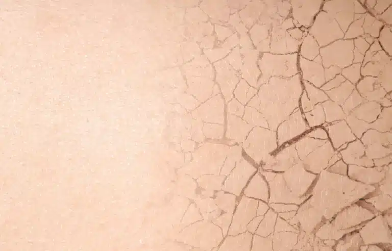 Piele uscată și crăpată - deshidratare severă care necesită tratament hidratant intensiv